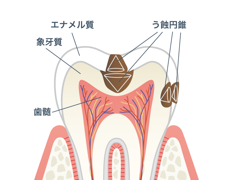 小さなむし歯も要注意！「う蝕円錐」とは？